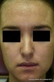 Melanage Chemical Peel for Melasma