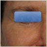 TCA Peel - Lower Lids