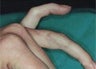 Tattoo Removal