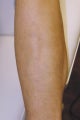 Tattoo Removal
