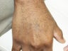 Tattoo Removal African American Skin
