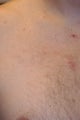 Tattoo Removal