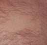 Los Angeles Tattoo Removal
