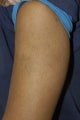 African American Tattoo Removal
