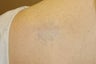 Laser Tattoo removal
