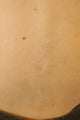Tattoo Removal