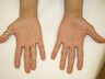 Tattoo Removal