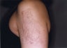 Laser Tattoo Removal