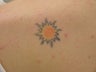 Tattoo Removal