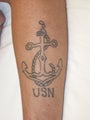 Tattoo Removal