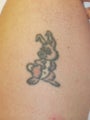 Laser Tattoo Removal