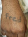 Tattoo Removal African American Skin