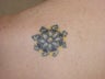 Laser Tattoo removal
