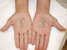 Tattoo Removal