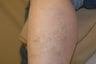Tattoo Removal