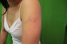 Laser Tattoo Removal