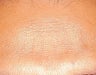 Laser tattoo removal