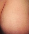 Laser tattoo removal