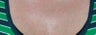 Laser tattoo removal
