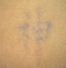 Laser tattoo removal 