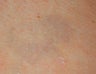 Laser tattoo removal 