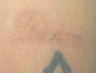 Laser tattoo removal