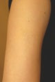 Tattoo Removal
