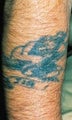 Laser tattoo removal 