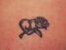Laser tattoo removal 