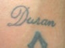 Laser tattoo removal