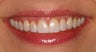 Deep bleaching and porcelain veneers