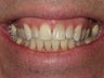 Whitening with walking bleach