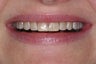 Composite veneers along with whitening