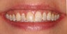Deep bleaching and porcelain veneers