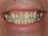 Whitening with walking bleach