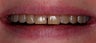 Composite veneers along with whitening