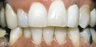 Teeth Whitening Smoking