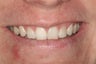 Whitening a single anterior tooth