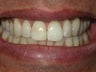 Internal Deep Bleaching