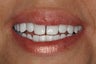 Teeth Whitening