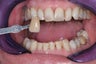 Whitening