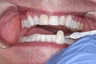 Whitening