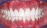 Whitening and Invisalign
