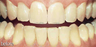 Whitening aging teeth