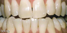 Teeth whitening genetic