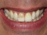 Internal Deep Bleaching