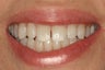 Teeth Whitening
