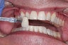Whitening
