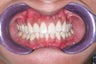 Whitening and Invisalign