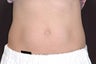 Thermage for Body - (Tummy/Abdomen)
